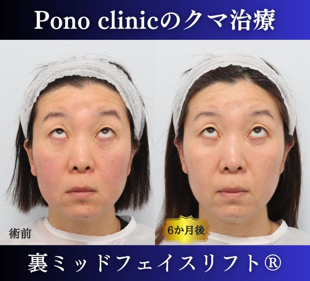 40代女性、目の下のクマ取り、裏ミッドフェイスリフト、裏ハムラ (5)