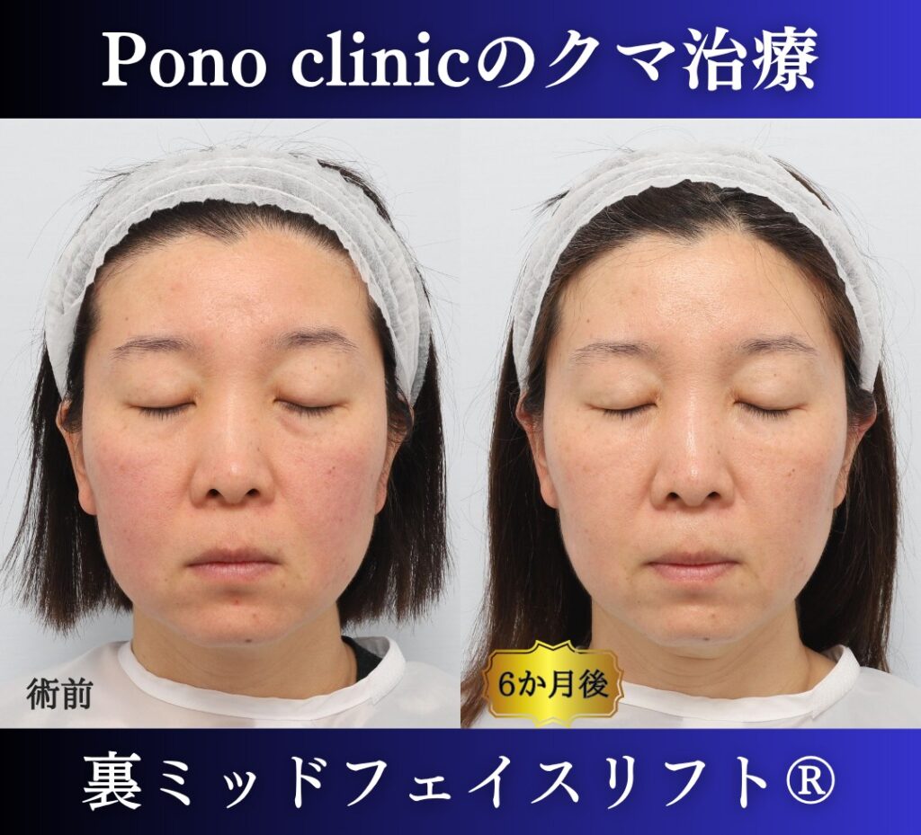 40代女性、目の下のクマ取り、裏ミッドフェイスリフト、裏ハムラ (6)