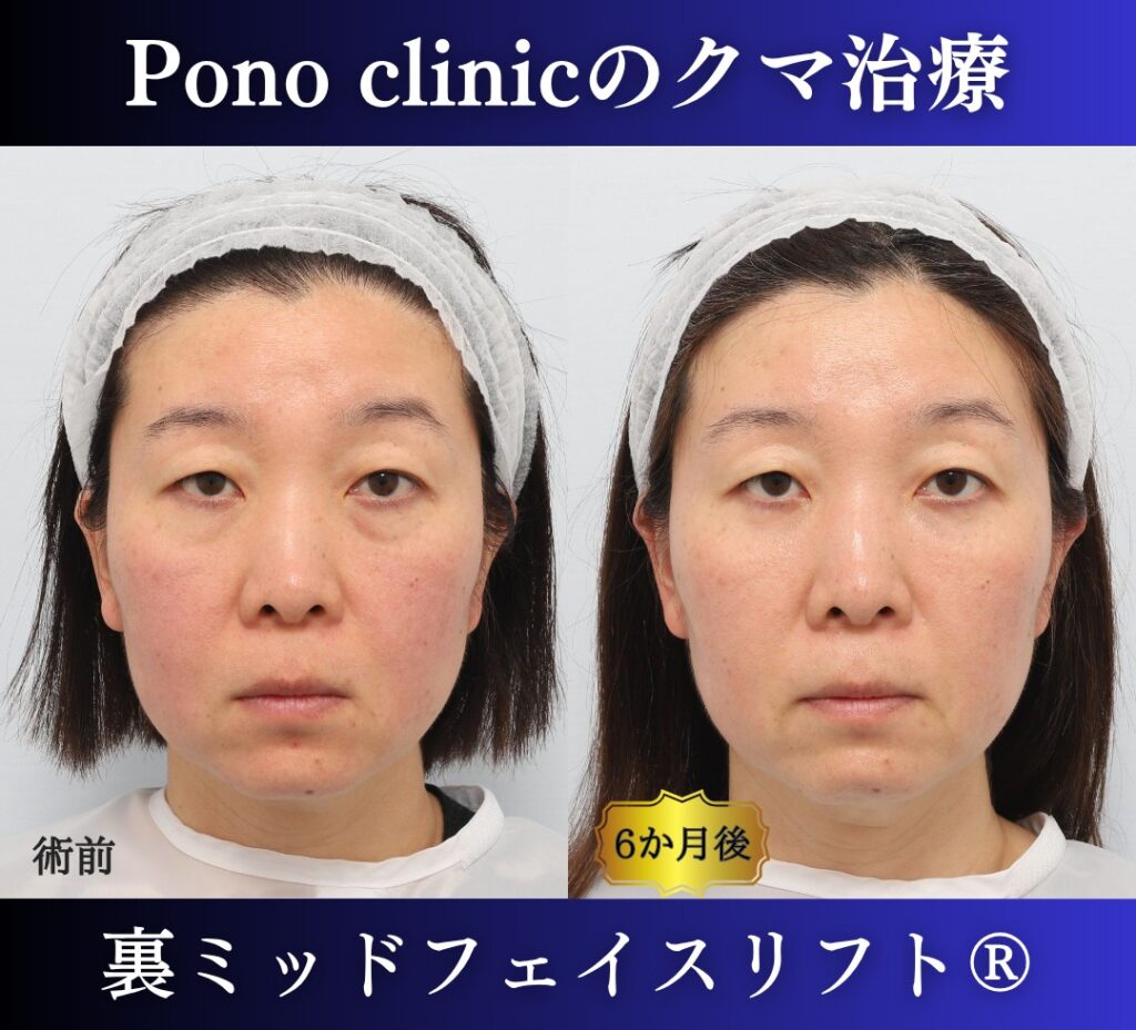 40代女性、目の下のクマ取り、裏ミッドフェイスリフト、裏ハムラ (7)