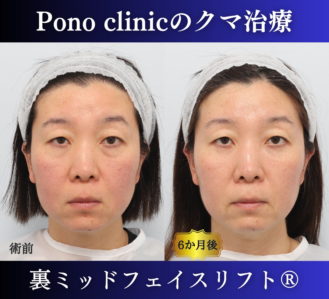 40代女性、目の下のクマ取り、裏ミッドフェイスリフト、裏ハムラ (7)