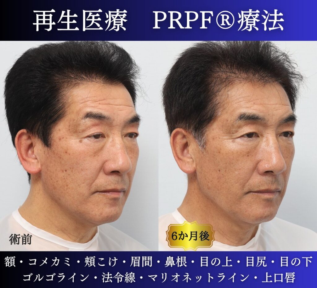 60代男性の症例、若返り治療、PRPF療法、法令線治療、しわ取り (1)
