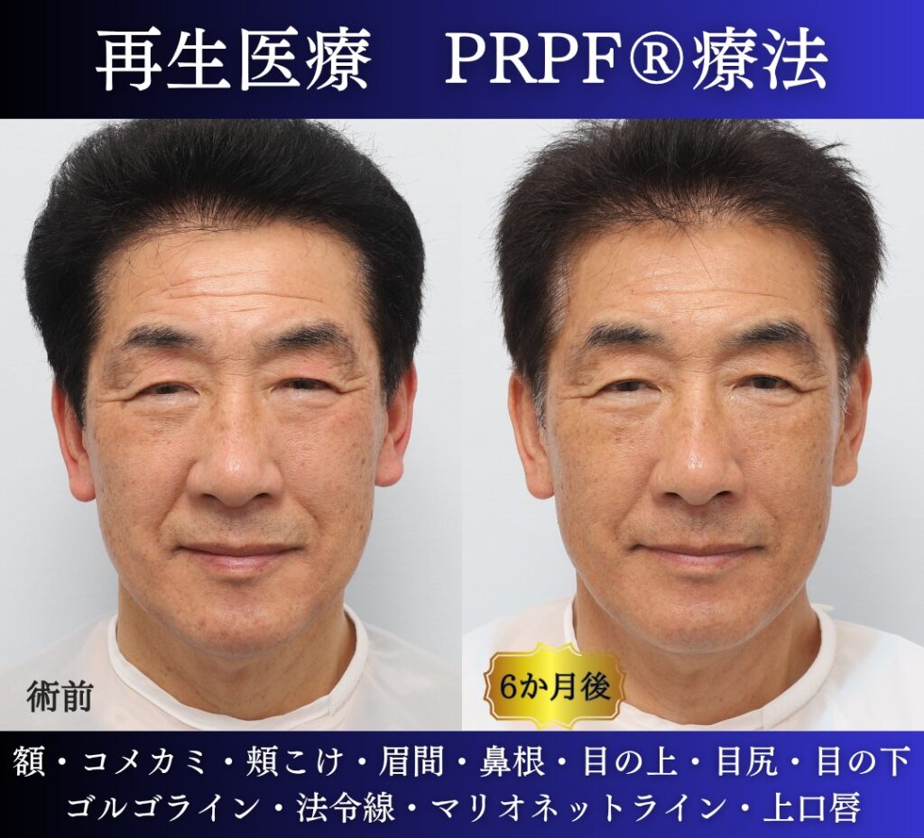 60代男性の症例、若返り治療、PRPF療法、法令線治療、しわ取り (3)