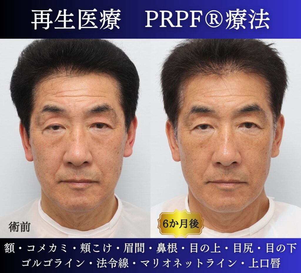 60代男性の症例、若返り治療、PRPF療法、法令線治療、しわ取り (4)