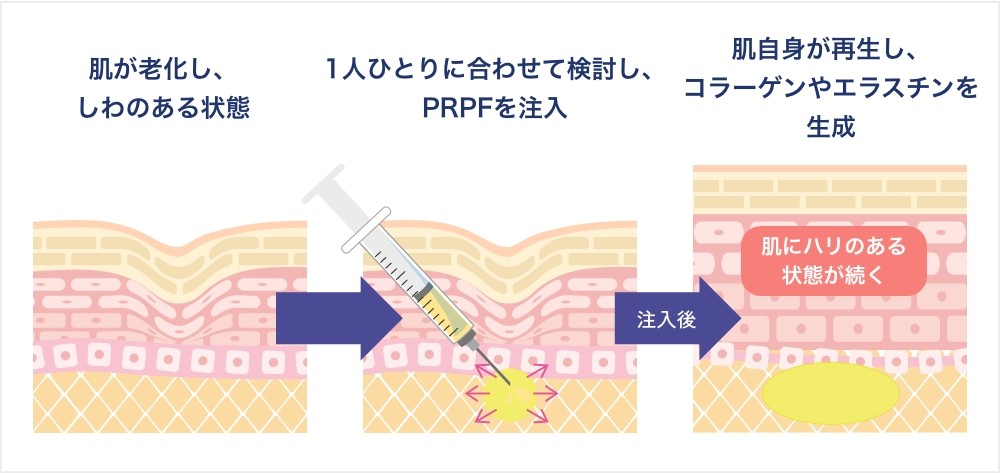 PRPF®療法
