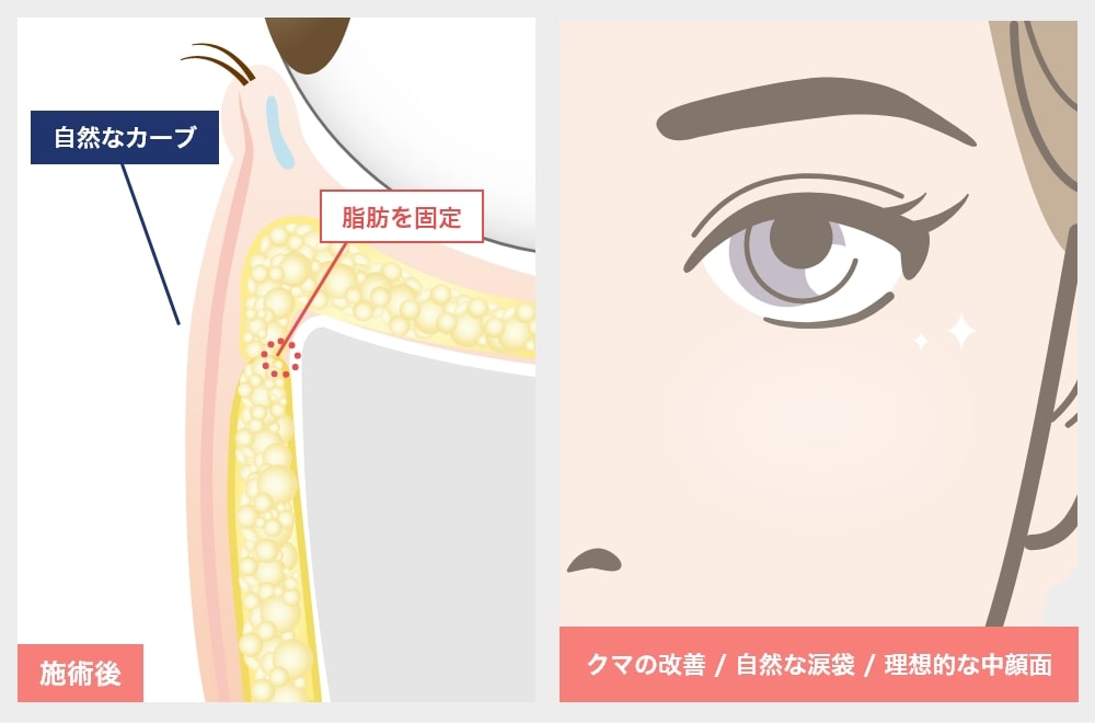 裏ミッドフェイスリフト®