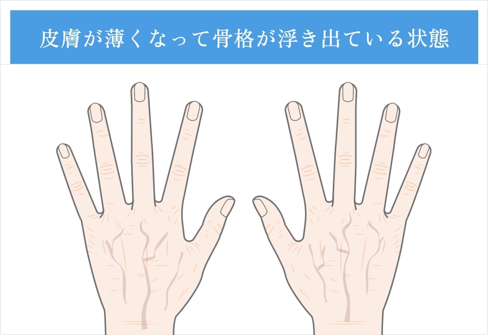 血管・骨ばりタイプ