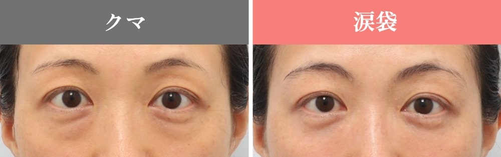 クマと涙袋の違い