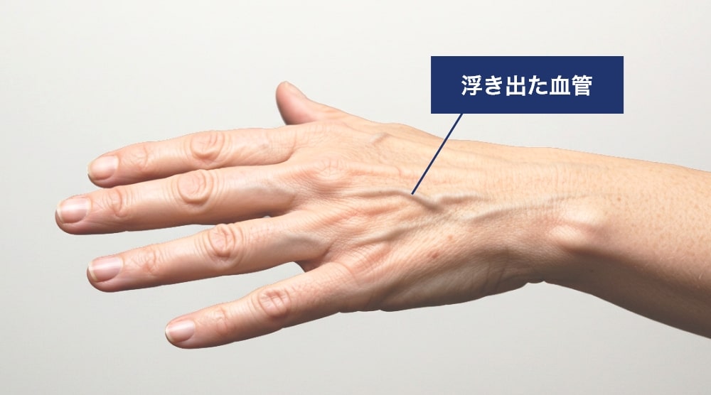 手の血管が浮き出る原因