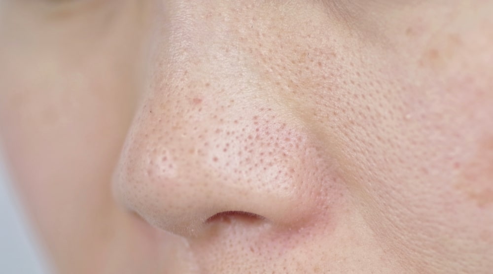 40代に多いたるみ毛穴とは