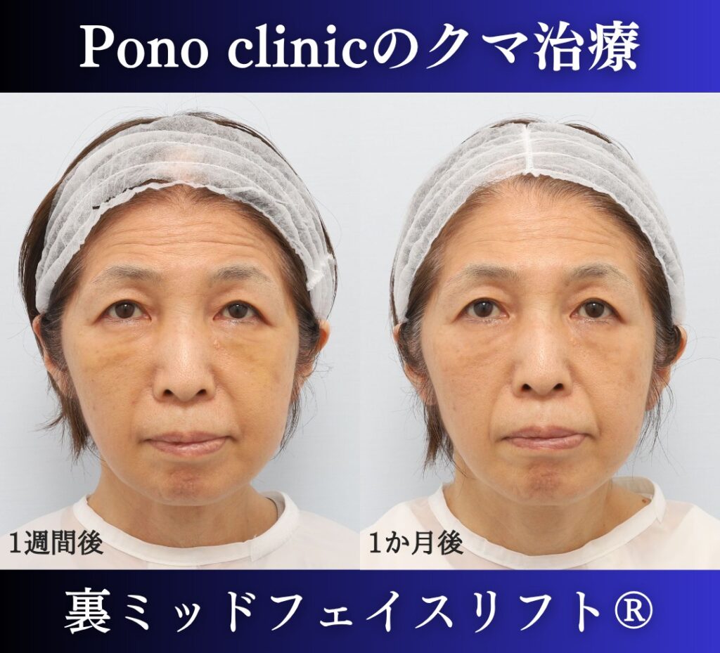 目の下のクマ取り、裏ハムラ法、50代女性の症例 (1)