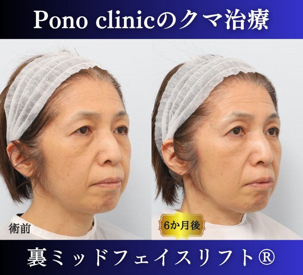 目の下のクマ取り、裏ハムラ法、50代女性の症例 (2)