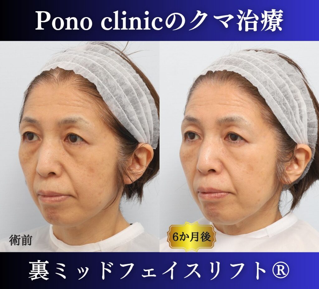 目の下のクマ取り、裏ハムラ法、50代女性の症例 (3)