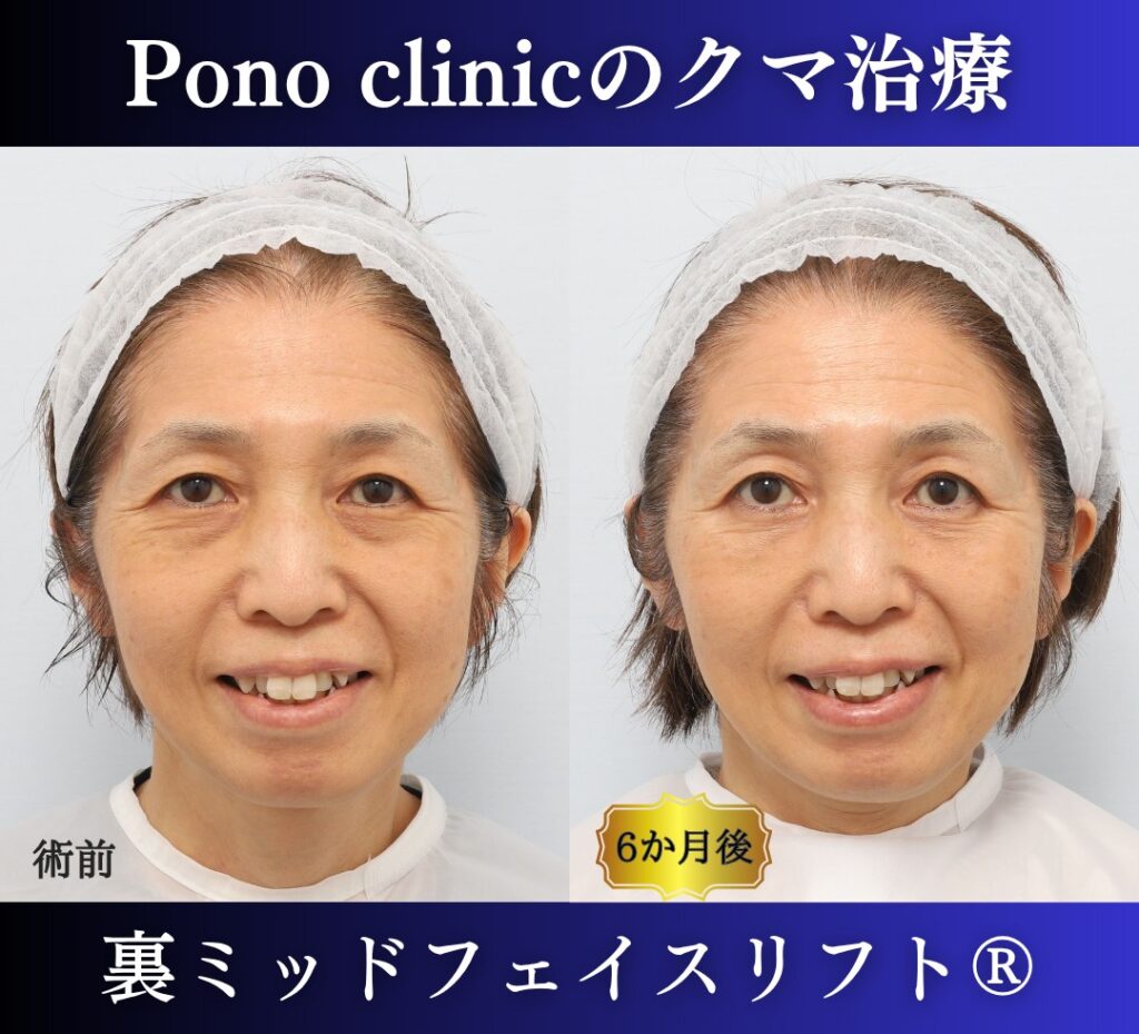 目の下のクマ取り、裏ハムラ法、50代女性の症例 (4)