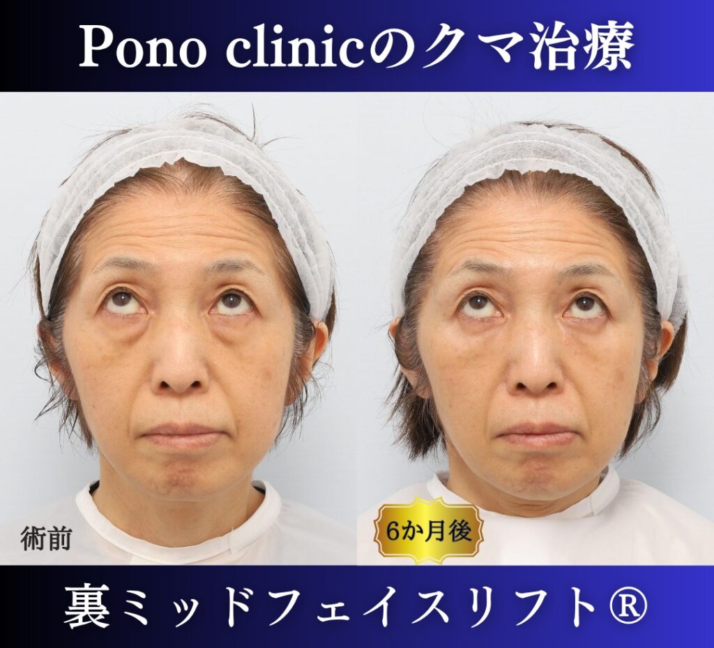 目の下のクマ取り、裏ハムラ法、50代女性の症例 (5)