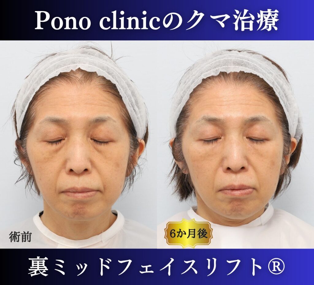 目の下のクマ取り、裏ハムラ法、50代女性の症例 (6)