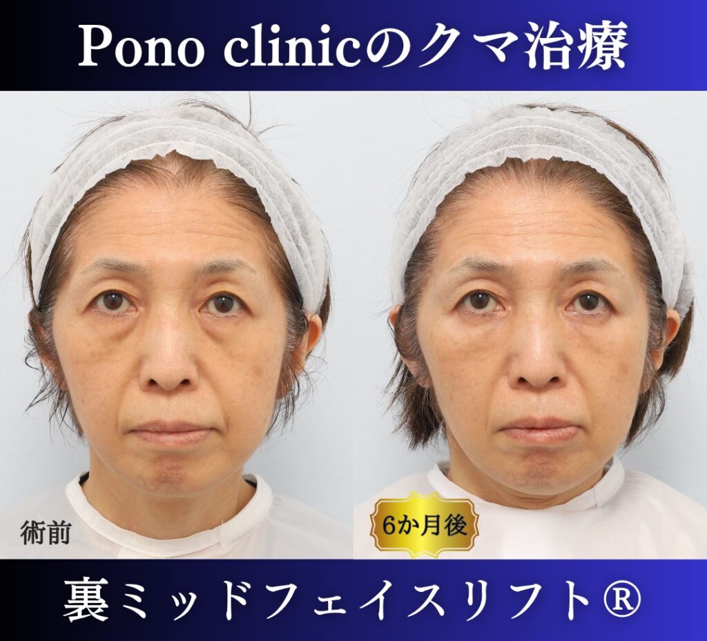 目の下のクマ取り、裏ハムラ法、50代女性の症例 (7)