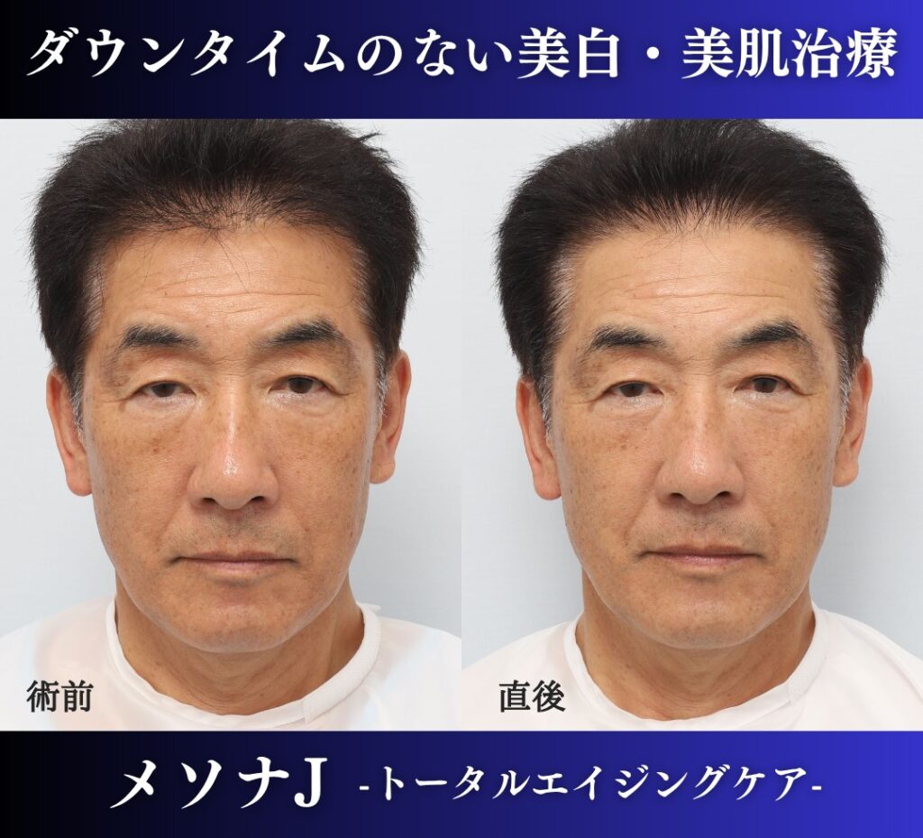 美肌治療、美白治療、メソナJ、トータルエイジングケア