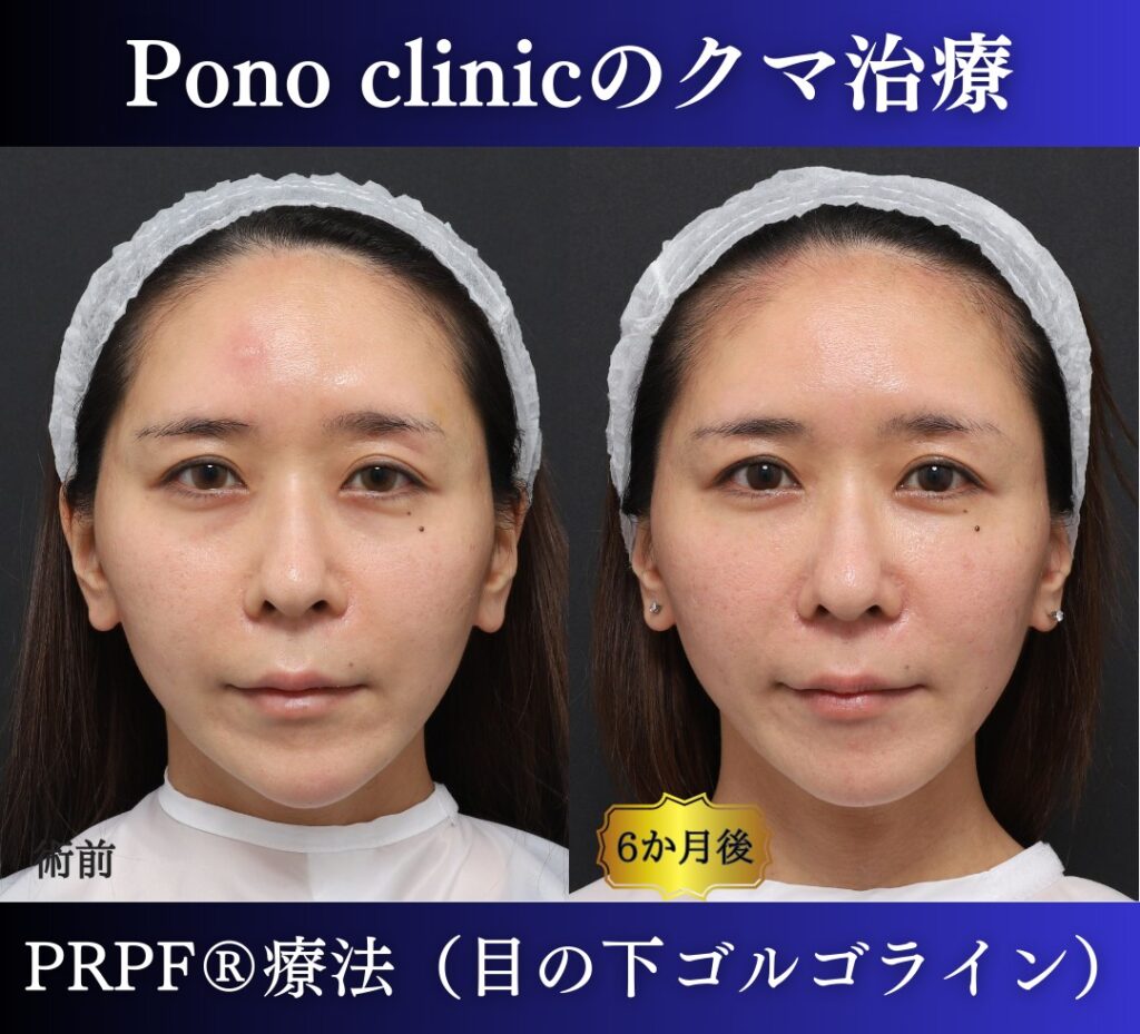 30代女性の症例、目の下のクマ、切らないクマ取り、再生医療、クマ取り注射 (1)