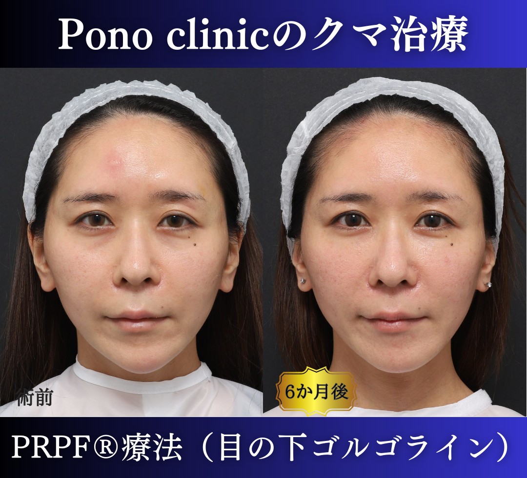 30代女性の症例、目の下のクマ、切らないクマ取り、再生医療、クマ取り注射 (1)