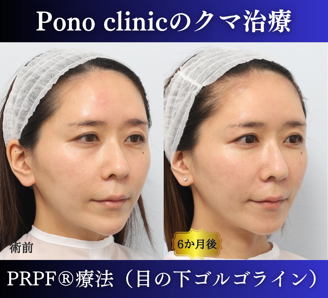 30代女性の症例、目の下のクマ、切らないクマ取り、再生医療、クマ取り注射 (2)