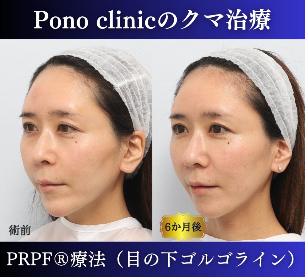 30代女性の症例、目の下のクマ、切らないクマ取り、再生医療、クマ取り注射 (3)