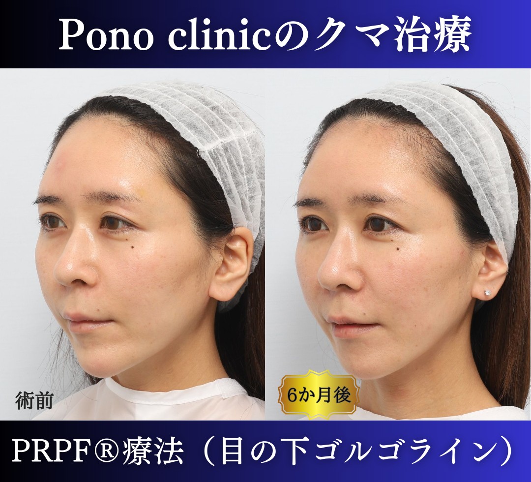 30代女性の症例、目の下のクマ、切らないクマ取り、再生医療、クマ取り注射 (3)