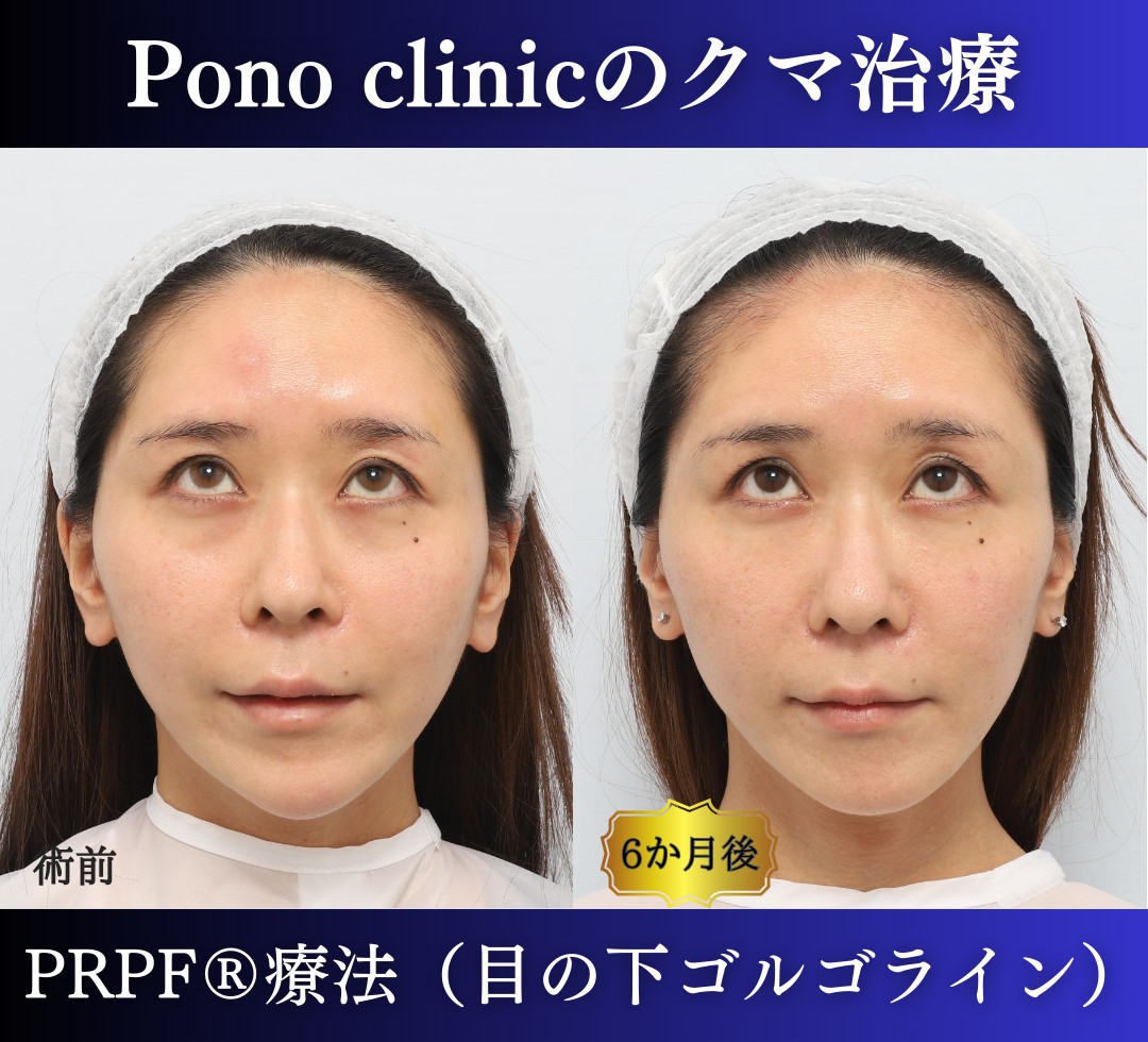 30代女性の症例、目の下のクマ、切らないクマ取り、再生医療、クマ取り注射 (4)