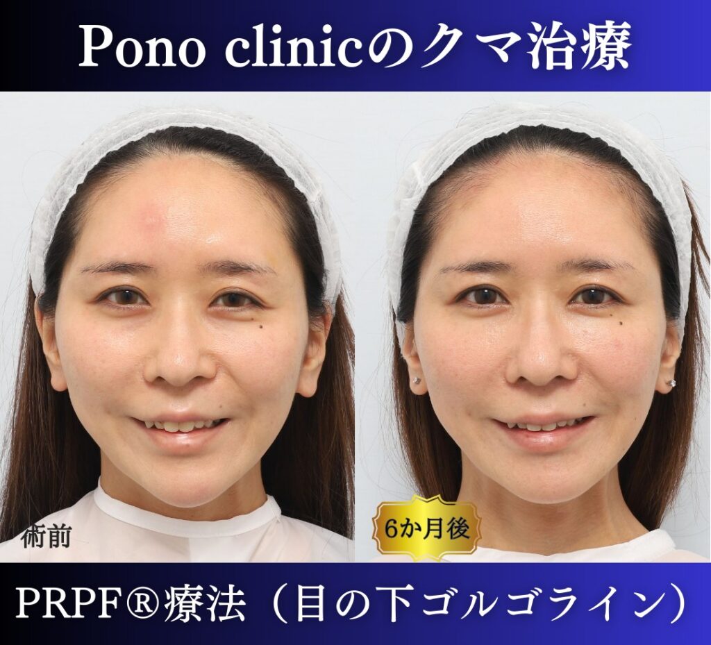 30代女性の症例、目の下のクマ、切らないクマ取り、再生医療、クマ取り注射 (5)