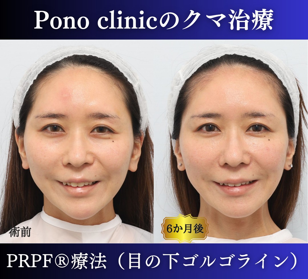 30代女性の症例、目の下のクマ、切らないクマ取り、再生医療、クマ取り注射 (5)