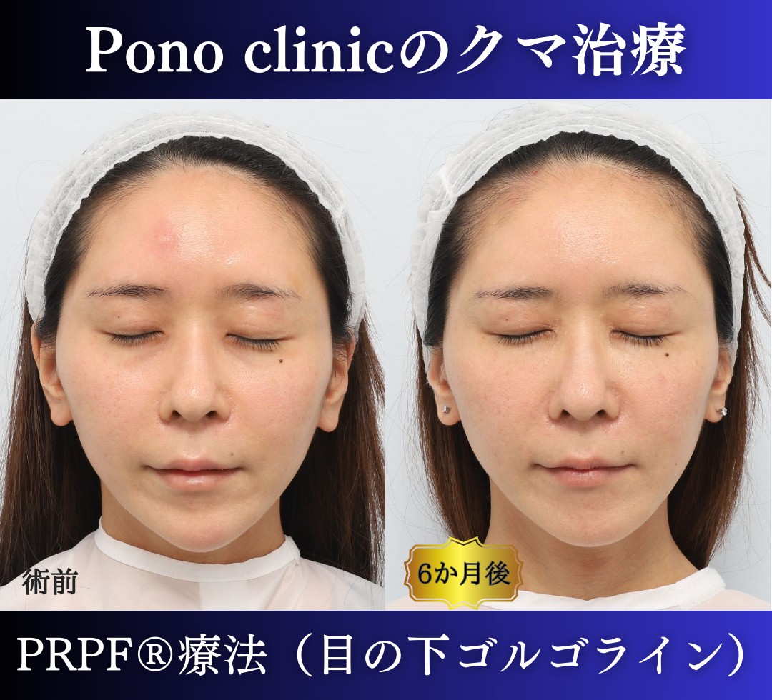 30代女性の症例、目の下のクマ、切らないクマ取り、再生医療、クマ取り注射 (6)