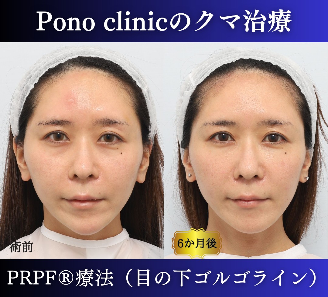 30代女性の症例、目の下のクマ、切らないクマ取り、再生医療、クマ取り注射 (7)