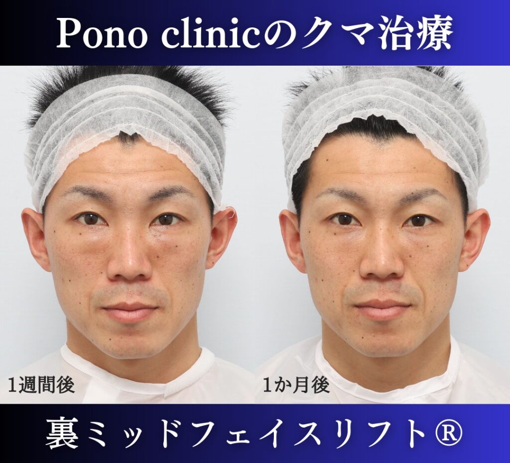 30代男性の症例、目の下のたるみ、裏ハムラ、ミッドフェイスリフト、裏ミッドフェイスリフト (1)