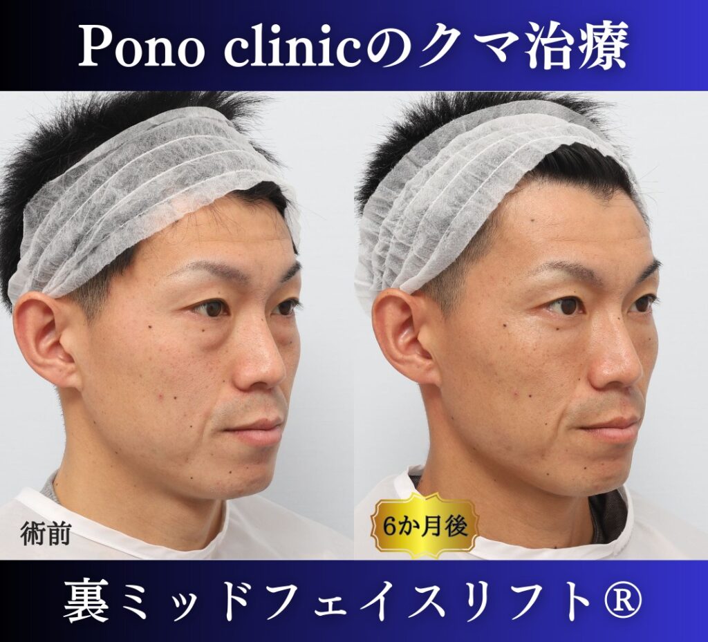 30代男性の症例、目の下のたるみ、裏ハムラ、ミッドフェイスリフト、裏ミッドフェイスリフト (2)