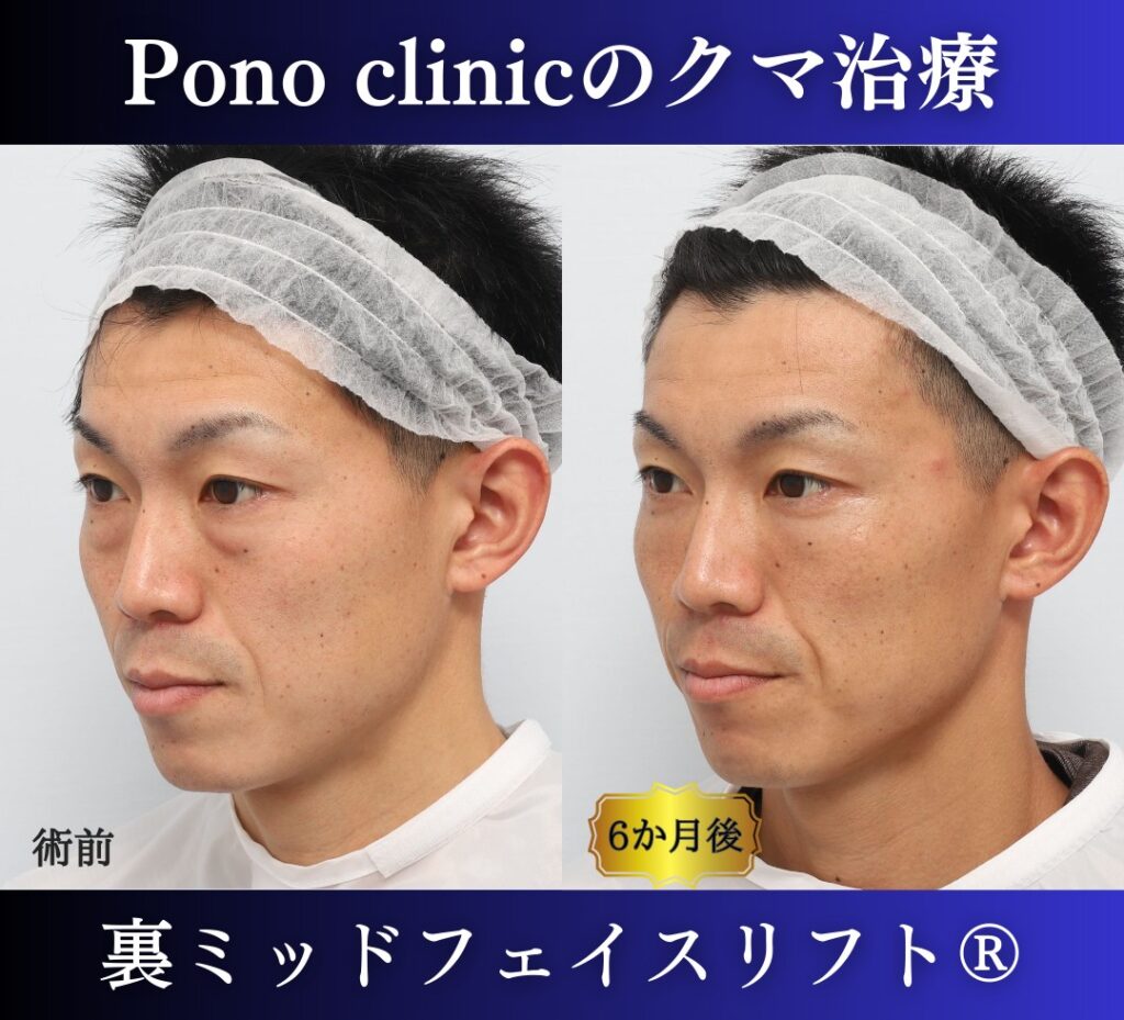 30代男性の症例、目の下のたるみ、裏ハムラ、ミッドフェイスリフト、裏ミッドフェイスリフト (3)