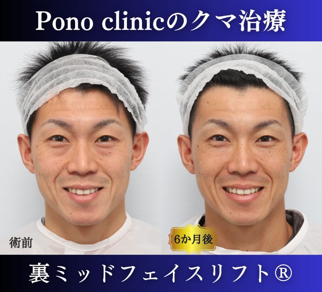 30代男性の症例、目の下のたるみ、裏ハムラ、ミッドフェイスリフト、裏ミッドフェイスリフト (4)