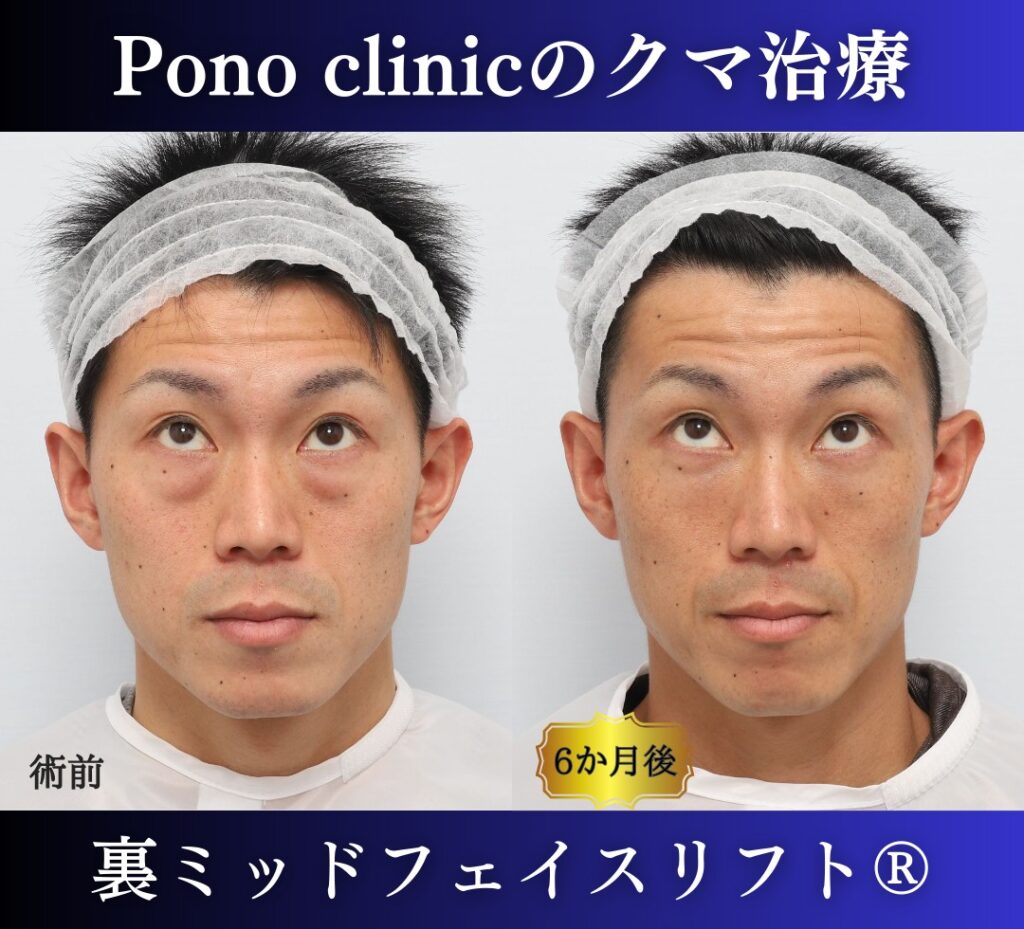 30代男性の症例、目の下のたるみ、裏ハムラ、ミッドフェイスリフト、裏ミッドフェイスリフト (5)