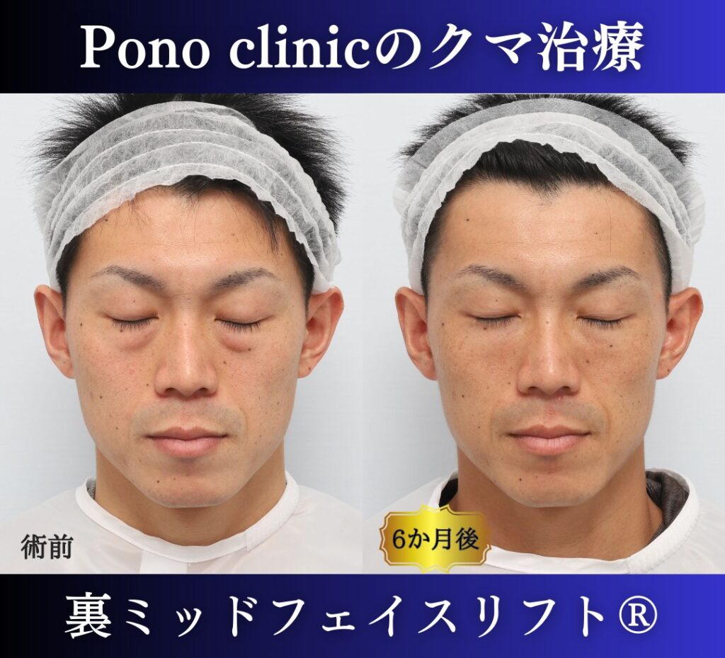 30代男性の症例、目の下のたるみ、裏ハムラ、ミッドフェイスリフト、裏ミッドフェイスリフト (6)