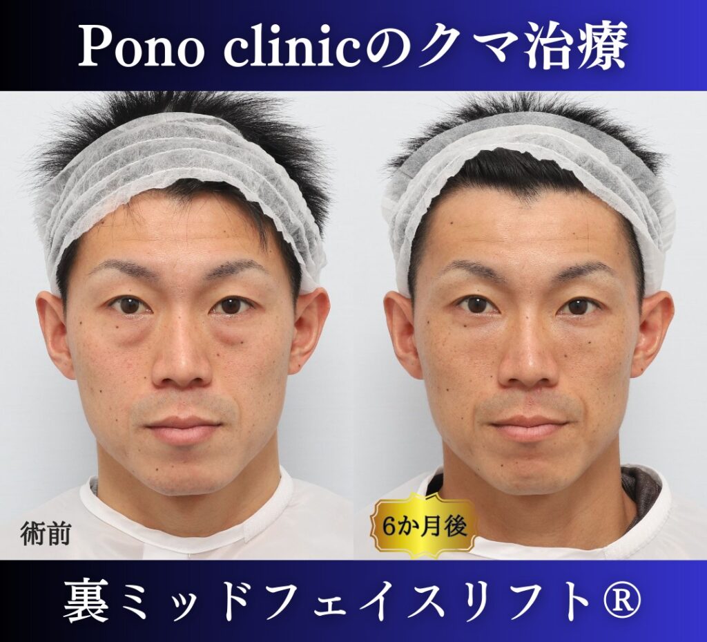 30代男性の症例、目の下のたるみ、裏ハムラ、ミッドフェイスリフト、裏ミッドフェイスリフト (7)