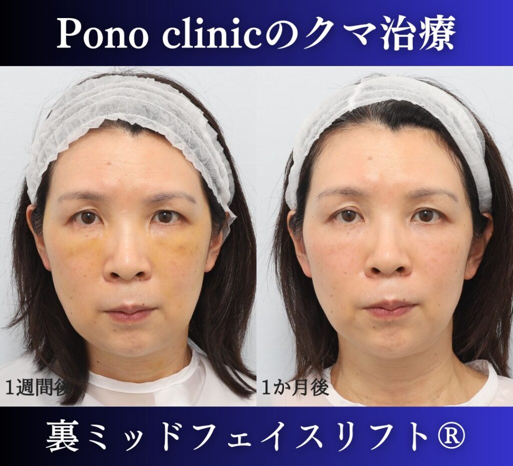 50代女性、目の下のクマ、裏ハムラ、ミッドフェイスリフト、裏ミッドフェイスリフトの症例 (1)