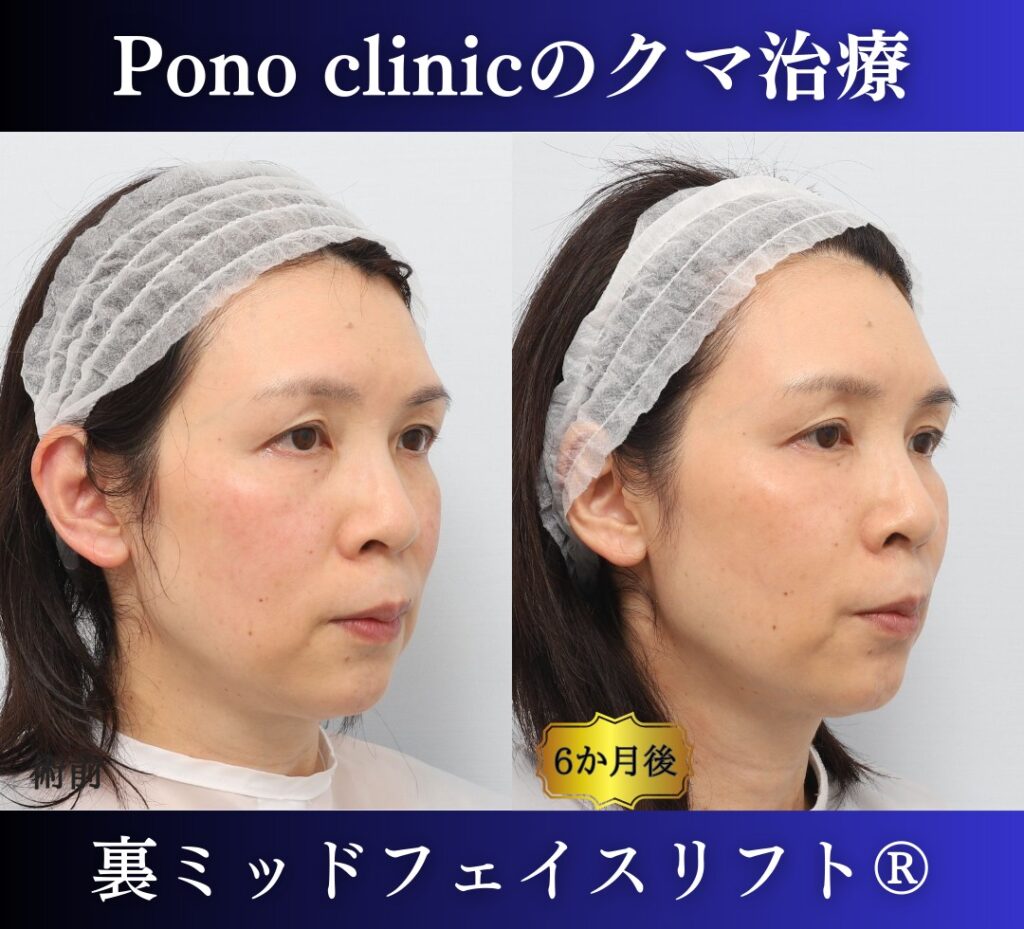 50代女性、目の下のクマ、裏ハムラ、ミッドフェイスリフト、裏ミッドフェイスリフトの症例 (2)