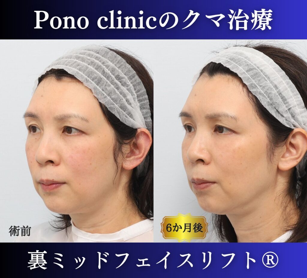 50代女性、目の下のクマ、裏ハムラ、ミッドフェイスリフト、裏ミッドフェイスリフトの症例 (3)