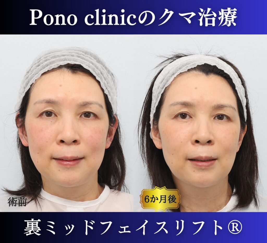 50代女性、目の下のクマ、裏ハムラ、ミッドフェイスリフト、裏ミッドフェイスリフトの症例 (4)