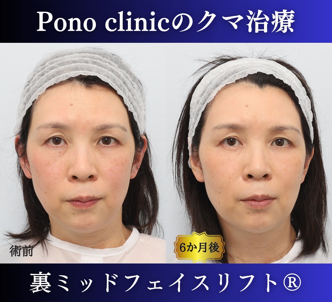 50代女性、目の下のクマ、裏ハムラ、ミッドフェイスリフト、裏ミッドフェイスリフトの症例 (7)