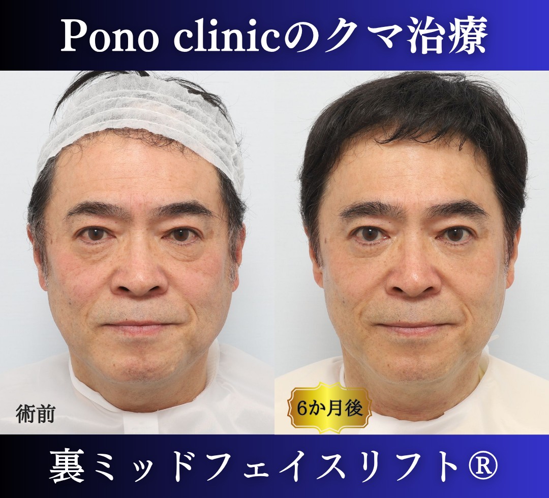 50代男性、目の下のクマ 、裏ハムラ、ミッドフェイスリフト、裏ミッドフェイスリフトの症例 (9)