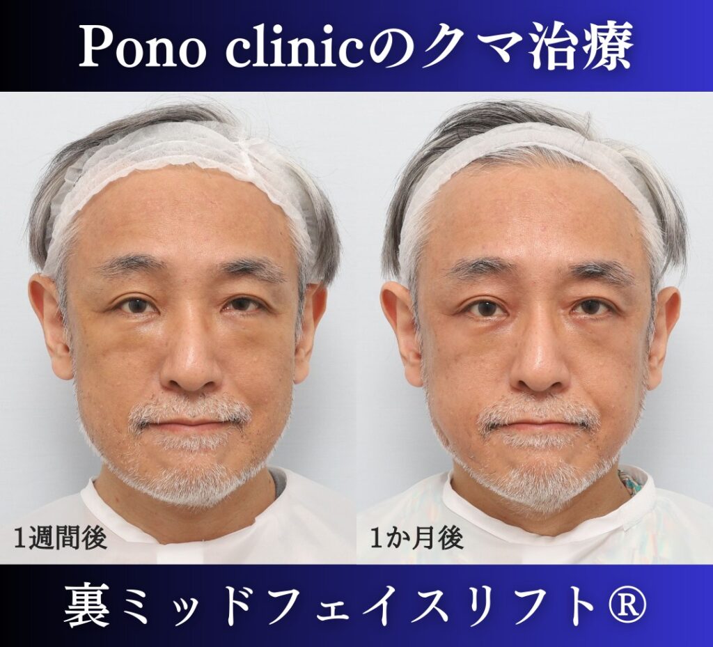 50代男性、目の下のクマ、 目の下のたるみ、裏ハムラ、ミッドフェイスリフト (1)