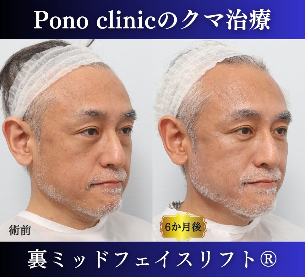 50代男性、目の下のクマ、 目の下のたるみ、裏ハムラ、ミッドフェイスリフト (2)