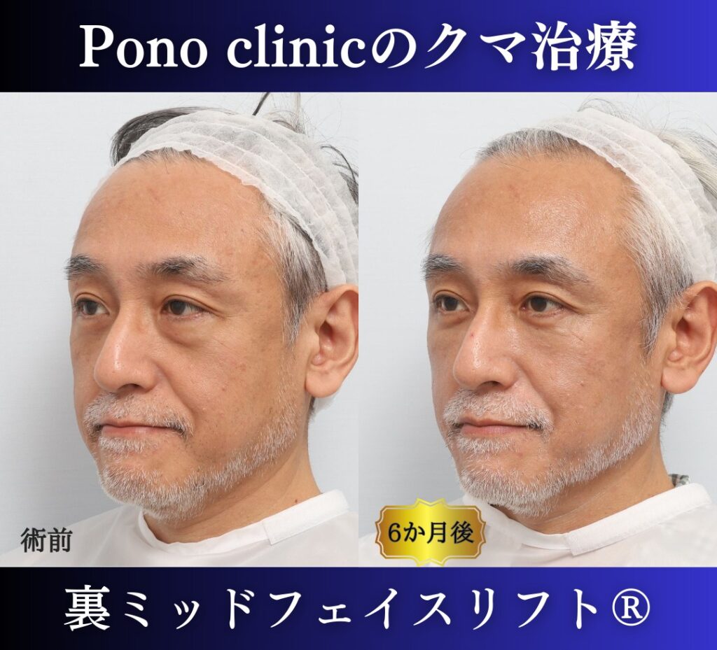 50代男性、目の下のクマ、 目の下のたるみ、裏ハムラ、ミッドフェイスリフト (3)