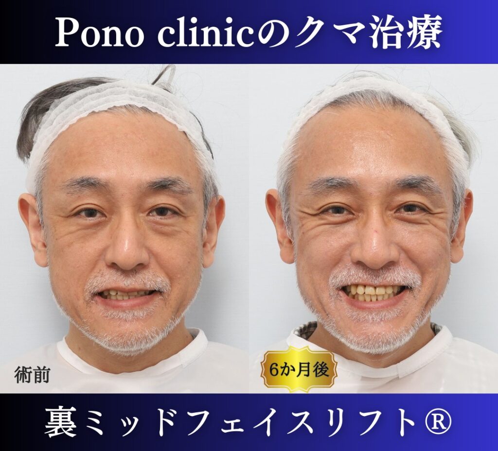 50代男性、目の下のクマ、 目の下のたるみ、裏ハムラ、ミッドフェイスリフト (4)