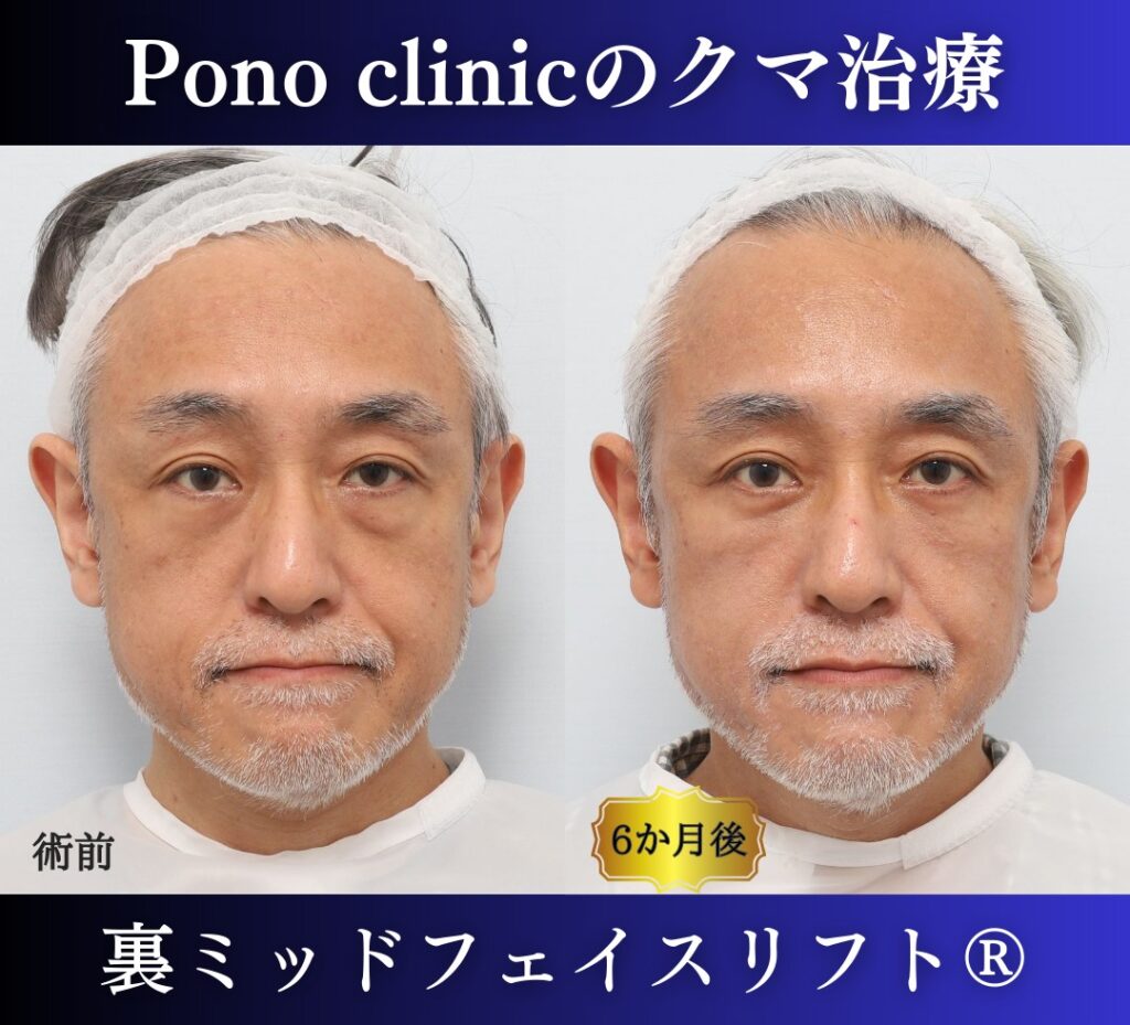 50代男性、目の下のクマ、 目の下のたるみ、裏ハムラ、ミッドフェイスリフト (5)