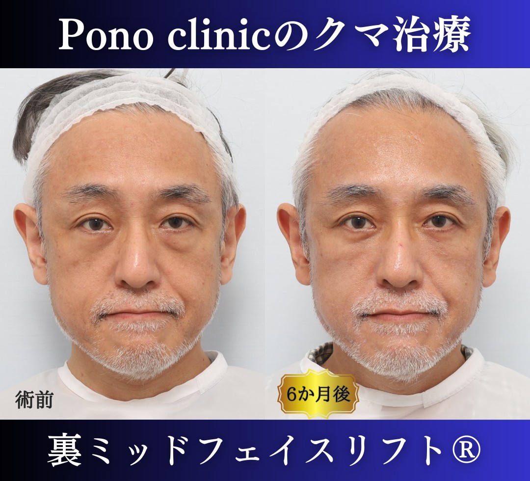 50代男性、目の下のクマ、 目の下のたるみ、裏ハムラ、ミッドフェイスリフト (5)
